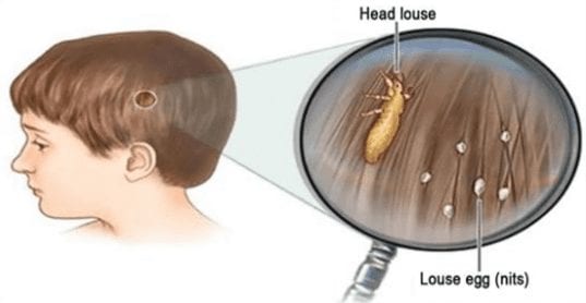 How To Get Rid Of Head Lice Fast Chemical Free That No Doctor Tells You About