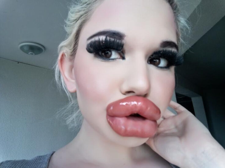 bulgarian woman aspiring to have biggest lips in the world undergoes 20th injection
