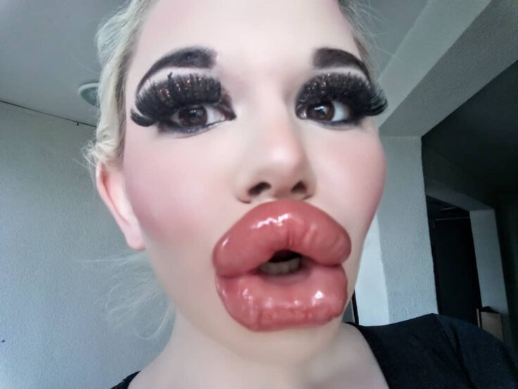 bulgarian woman aspiring to have biggest lips in the world undergoes 20th injection