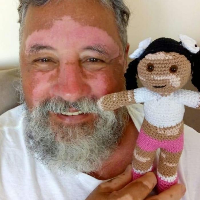 grandpa with vitiligo crochets inclusive dolls for kids with the condition to uplift their self-esteem