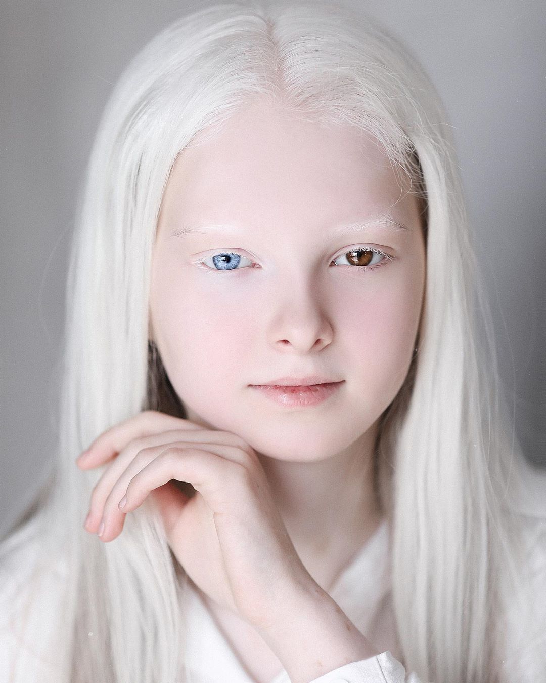 Amina Ependieva – A Girl Who Inherited Two Genetic Mutations And Exceptional Beauty