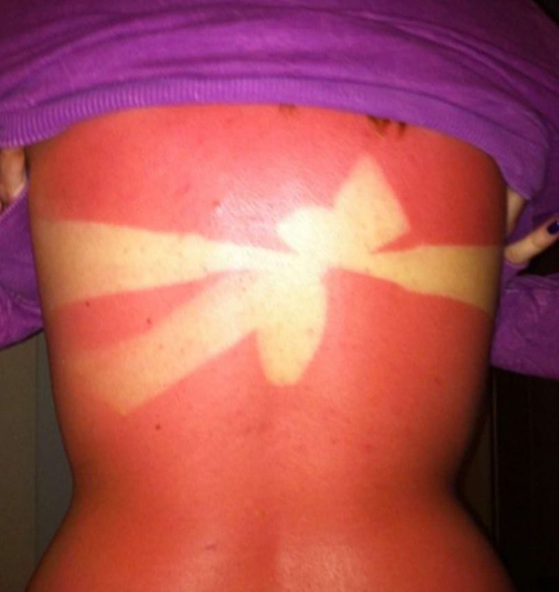 Some Of The Worst Sunburns On The Internet
