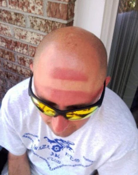 Some Of The Worst Sunburns On The Internet