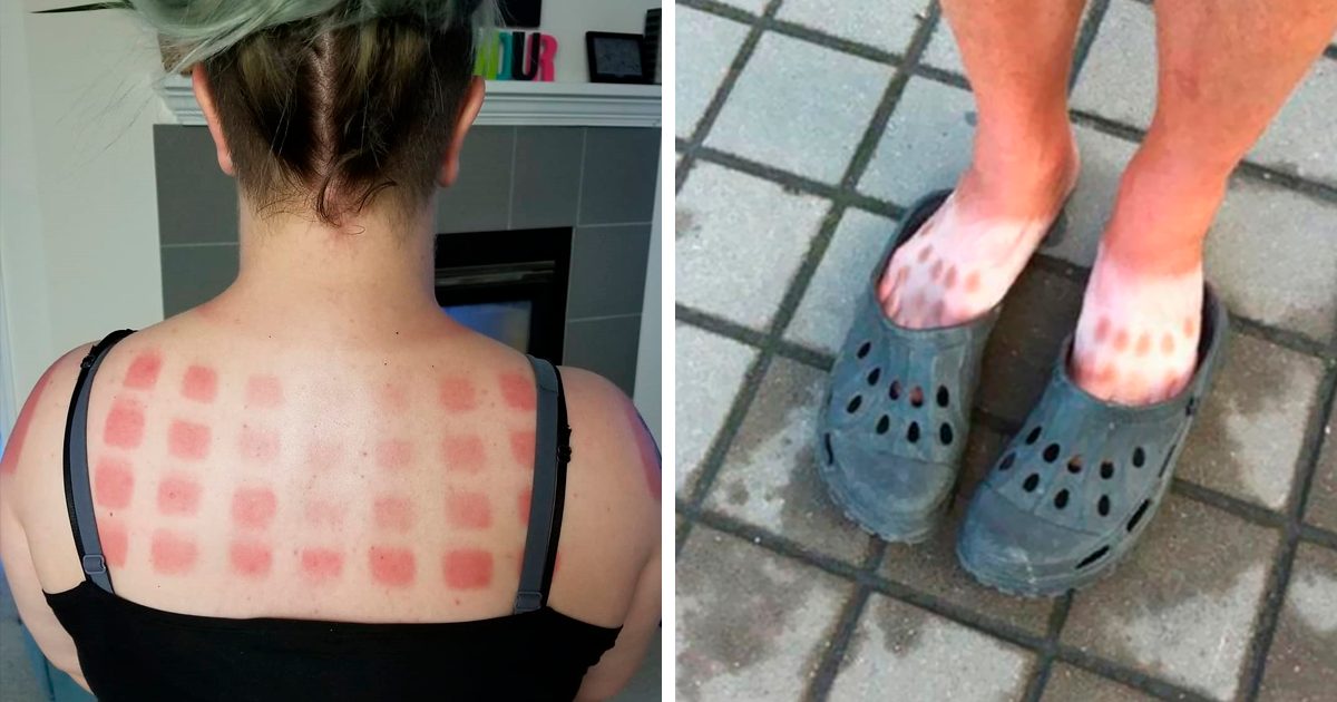 some of the worst sunburns on the internet