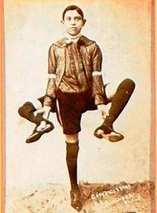 Who Was Frank Lentini, The Three-legged Football Player With 2 Penises And 4 Feet?