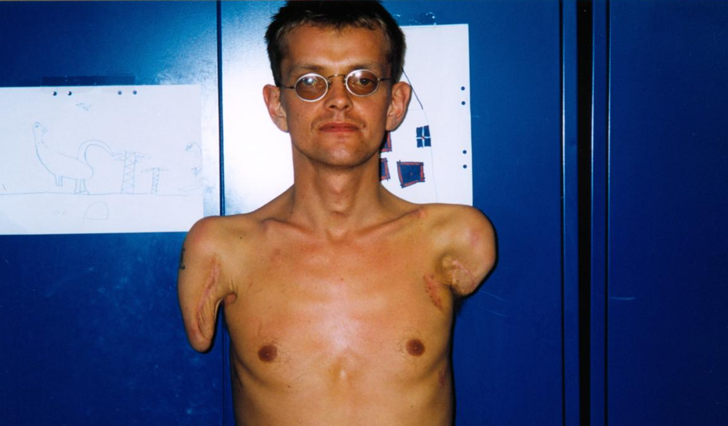 Man Who Had Double Arm And Shoulder Transplant Hugs Grandchildren