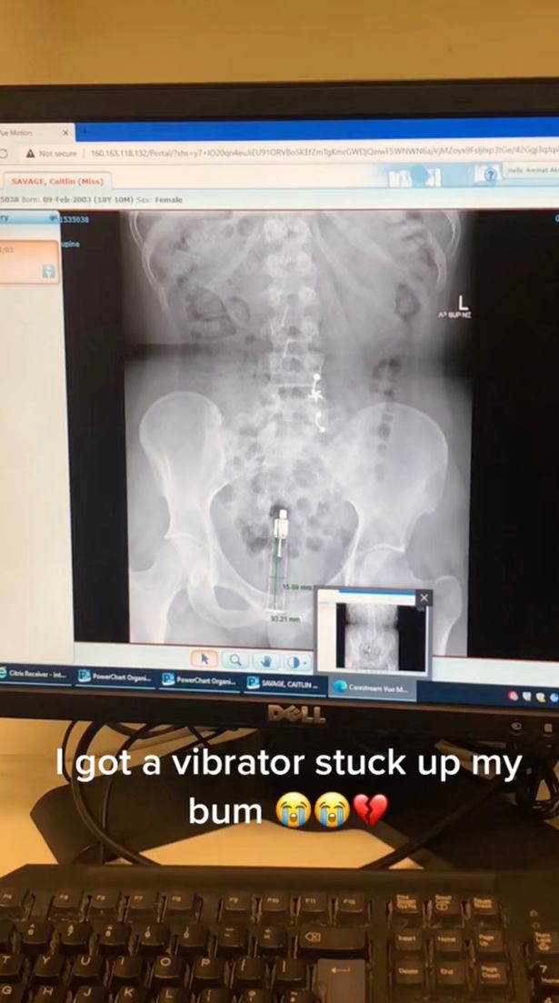"i Got A Vibrator Stuck So Far Up My Bum It Had To Be Surgically Removed"