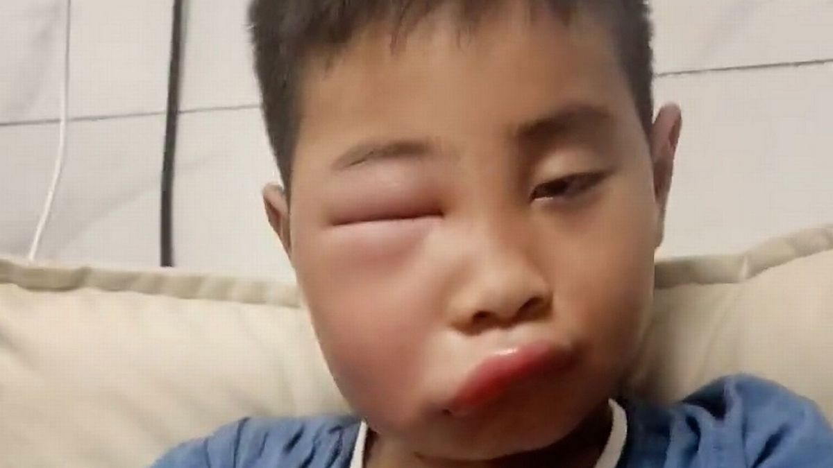 Boy's Face Swells Up Massively As He's Attacked By Swarm Of Bees After Constantly Poking Their Hive
