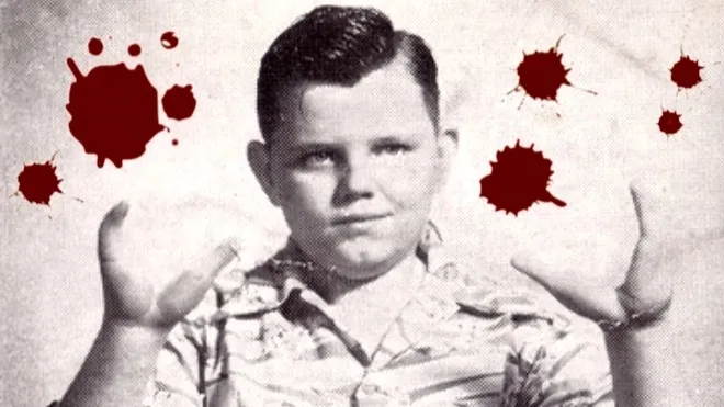 Grady Stiles – The Lobster Boy Who Killed One Of His Family Members