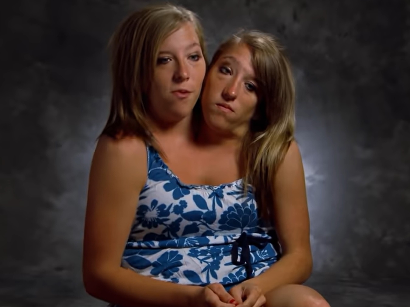 Conjoined Twins Opened Up On What Their Life Was Like After Becoming ...