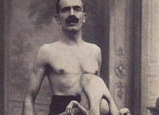 The Unusual Tale Of Jean Libbera, The Sideshow Artist With A Lifelong Companion: A Parasitic Twin