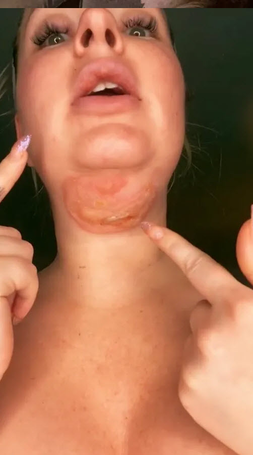 Woman Suffers Permanent Scars And Second-Degree Burns From Jaw-Sculpting Procedure