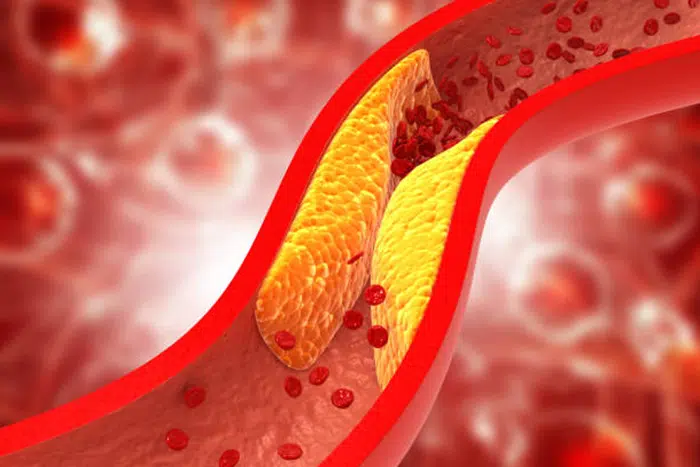 10 Indicators You Might Have Blocked Arteries