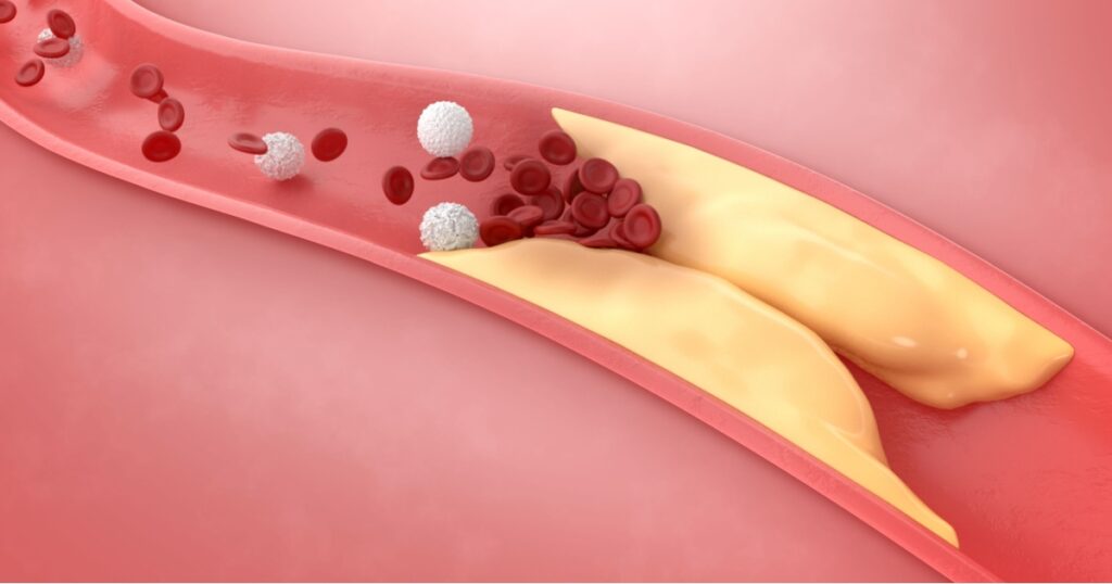 10 Indicators You Might Have Blocked Arteries