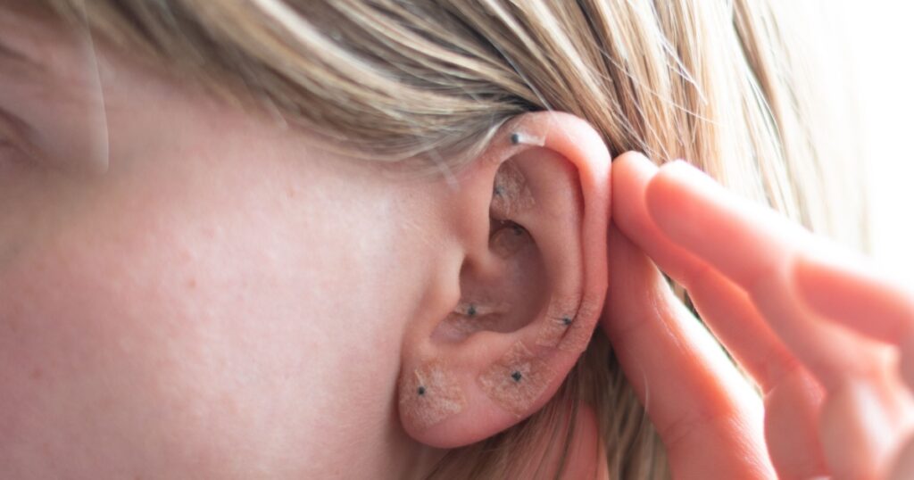 What's The Deal With Ear Seeds?