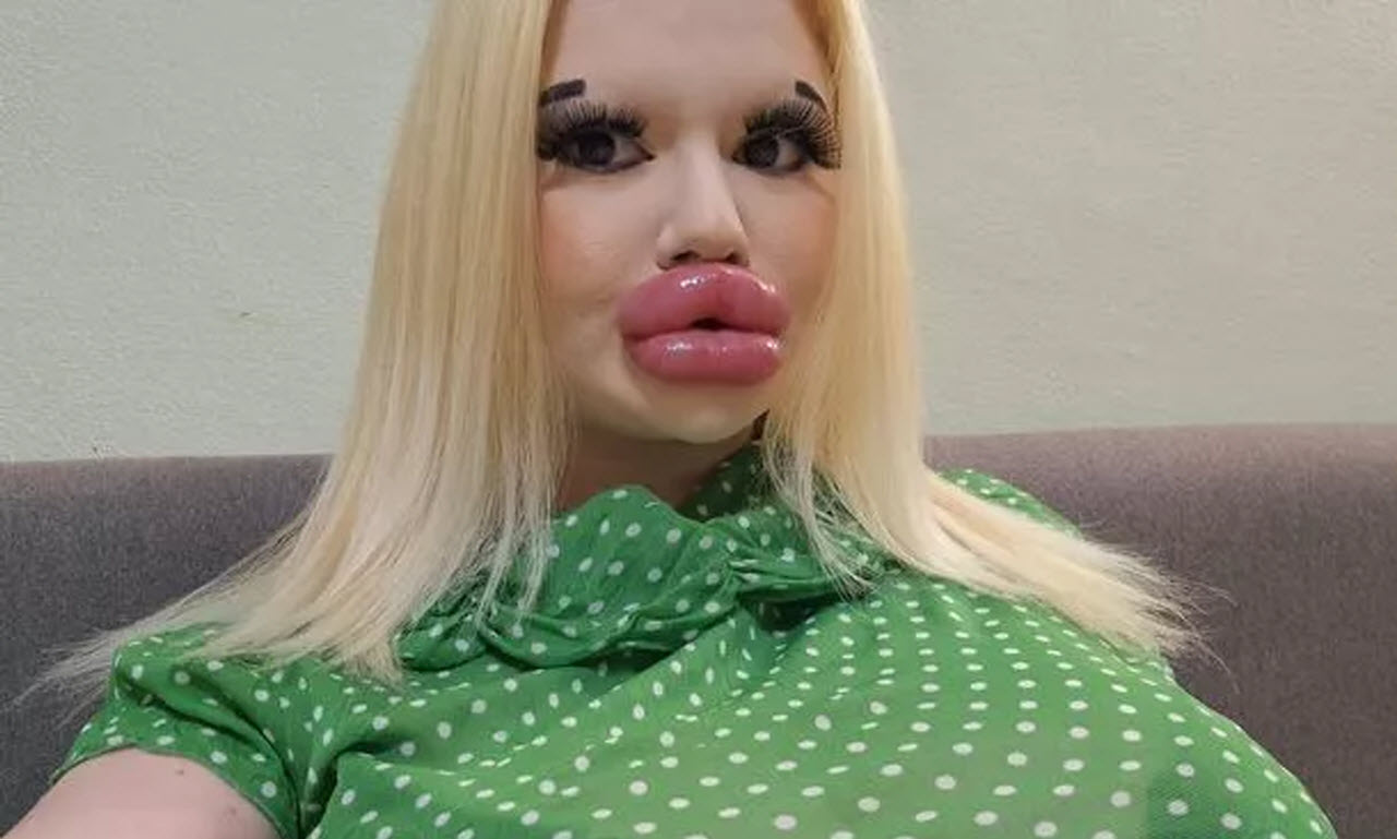 Young Woman Undergoes 27 Procedures To Achieve World's Largest Lips