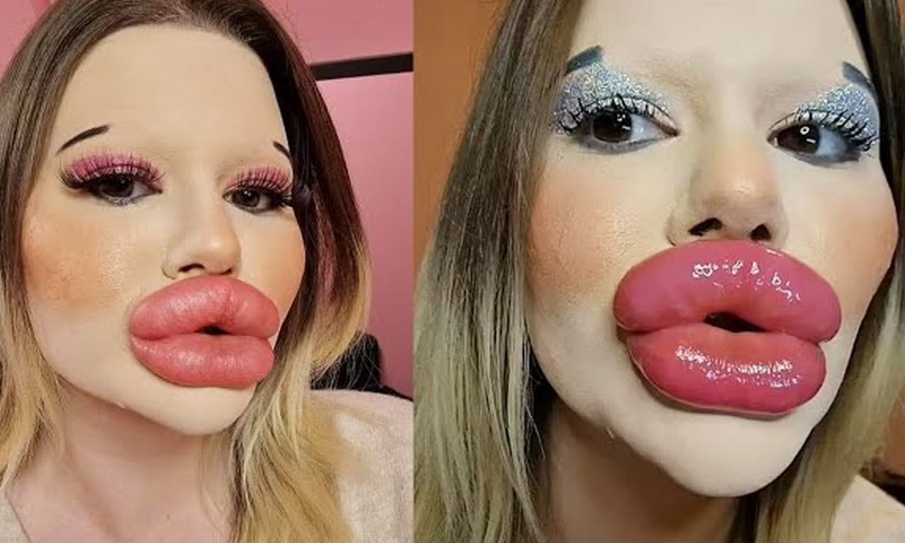 Young Woman Undergoes 27 Procedures To Achieve World's Largest Lips